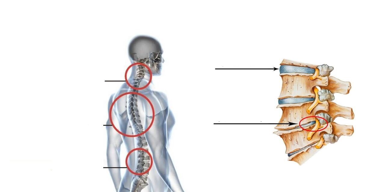Osteocondroza coloanei lombare